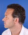 After Hair Transplant&nbsp;Temporal Hairline